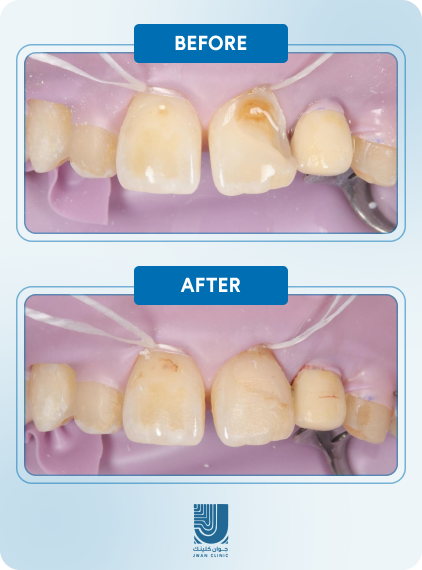 Before After 1