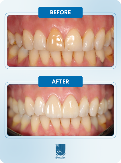 Before After 2