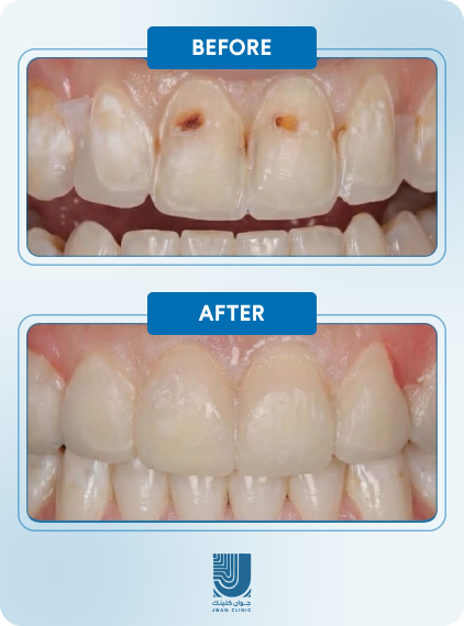Before After 3