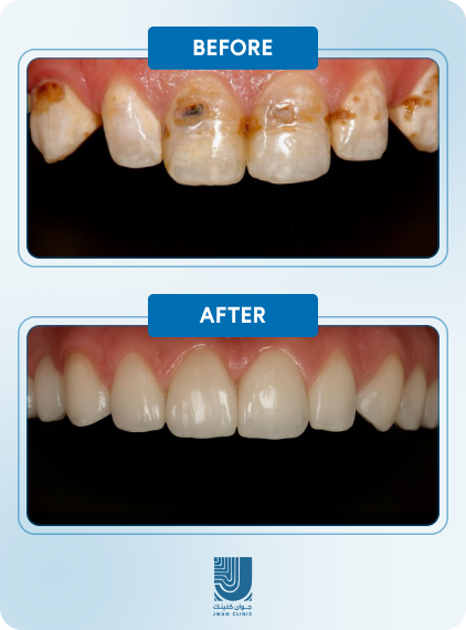 Before After 4