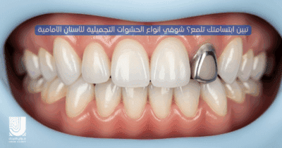 أنواع الحشوات التجميلية للاسنان الأمامية-جوان كلينك