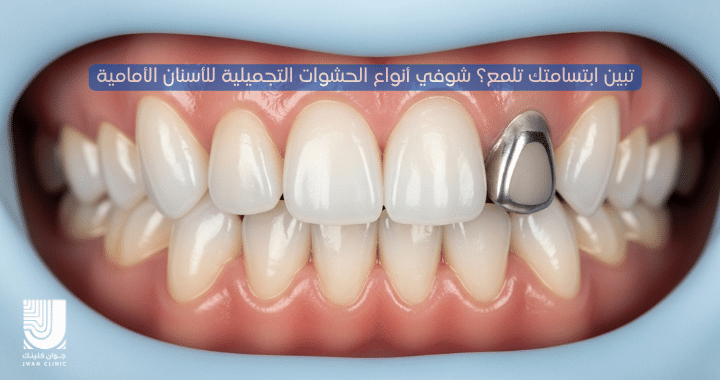 أنواع الحشوات التجميلية للاسنان الأمامية-جوان كلينك