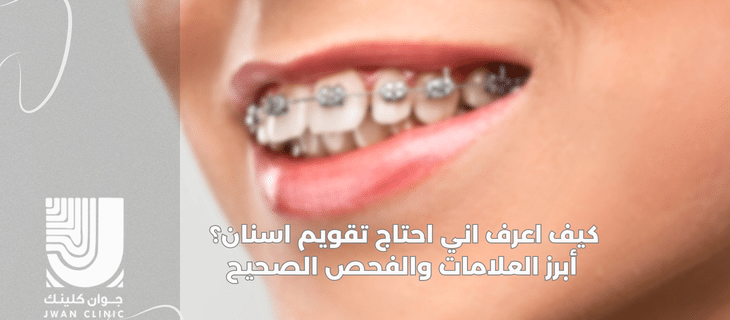 كيف اعرف اني احتاج تقويم اسنان